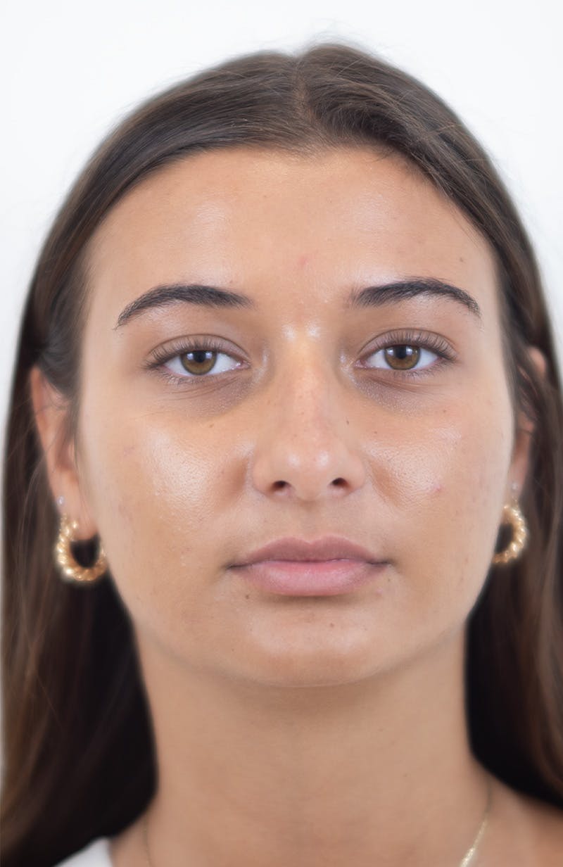Rhinoplasty Before & After Gallery - Patient 245130 - Image 3