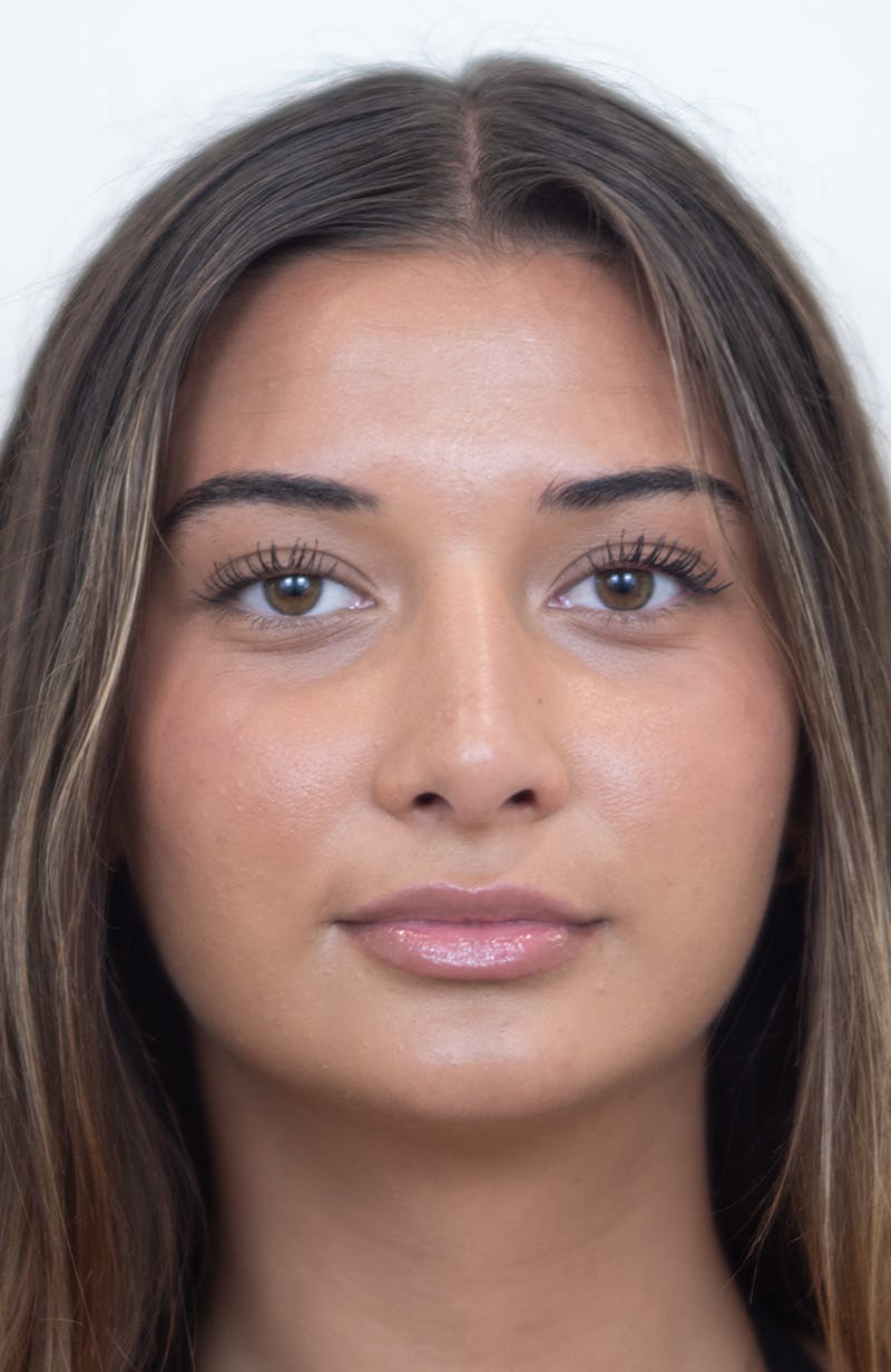Rhinoplasty Before & After Gallery - Patient 245130 - Image 4