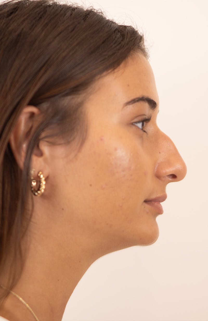 Rhinoplasty Before & After Gallery - Patient 245130 - Image 1