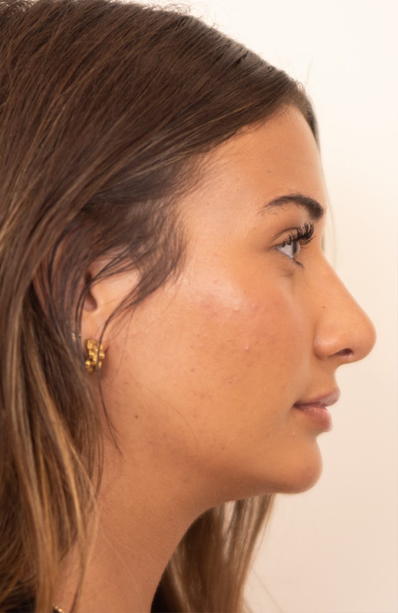 Rhinoplasty Before & After Gallery - Patient 245130 - Image 2