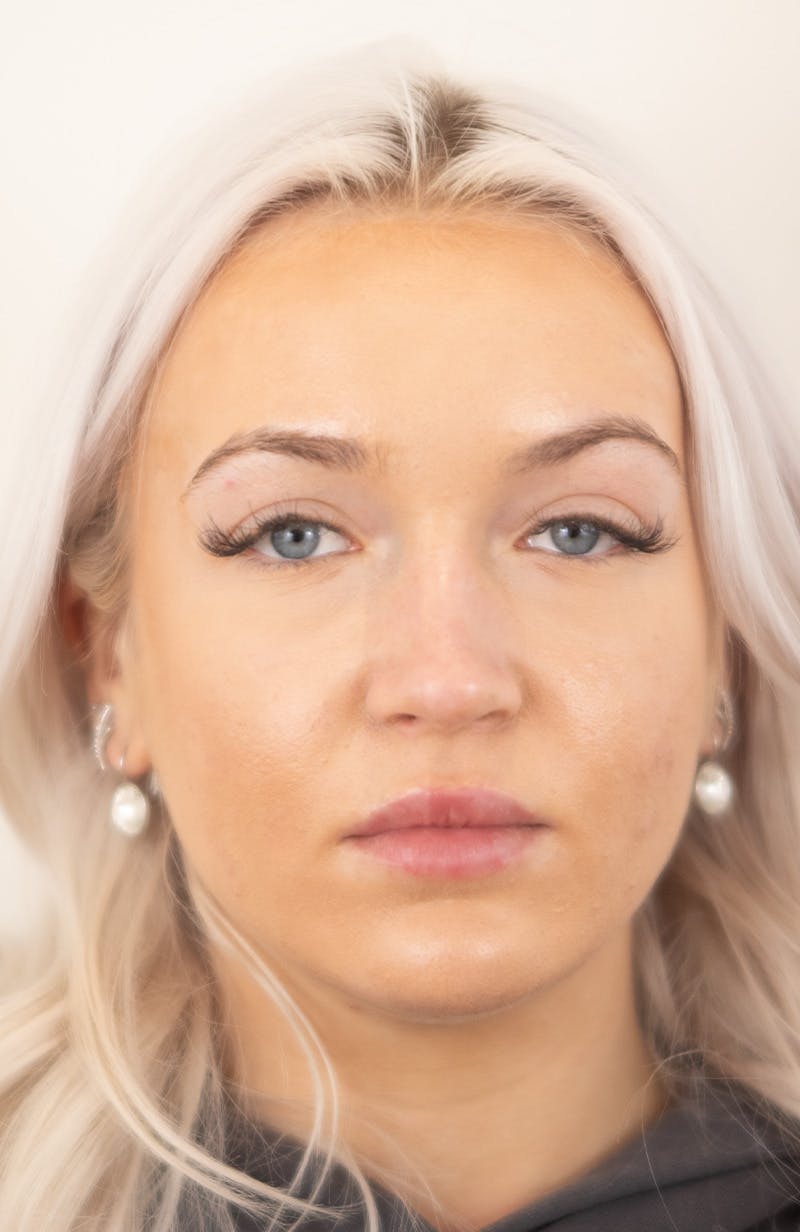 Rhinoplasty Before & After Gallery - Patient 153131 - Image 3