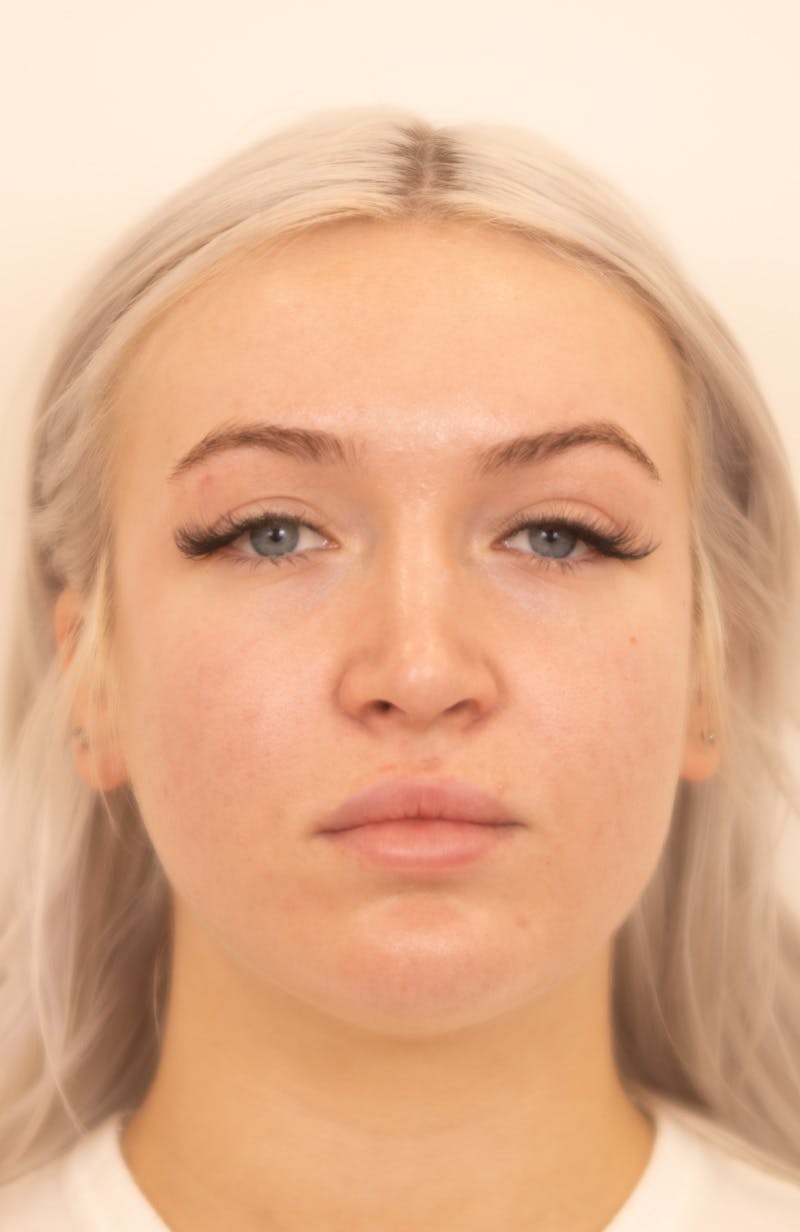 Rhinoplasty Before & After Gallery - Patient 153131 - Image 4