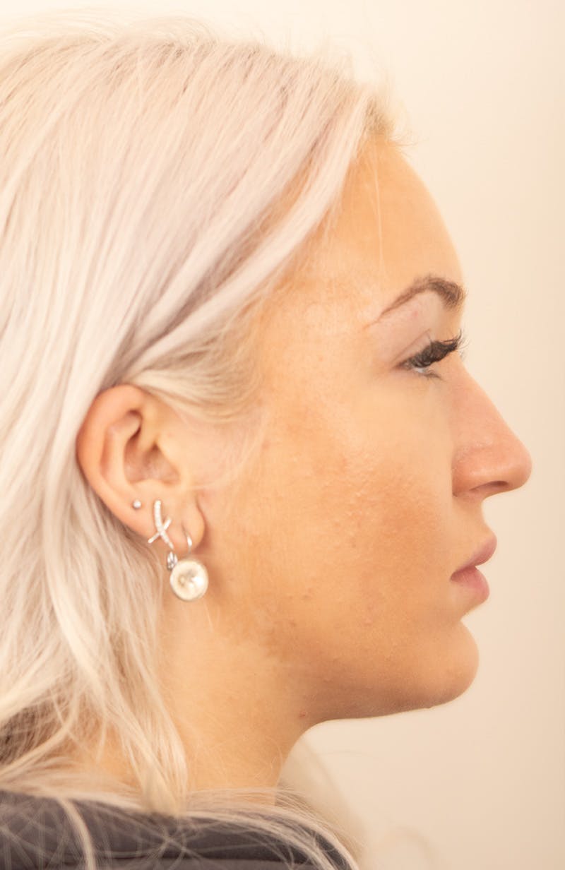 Rhinoplasty Before & After Gallery - Patient 153131 - Image 1