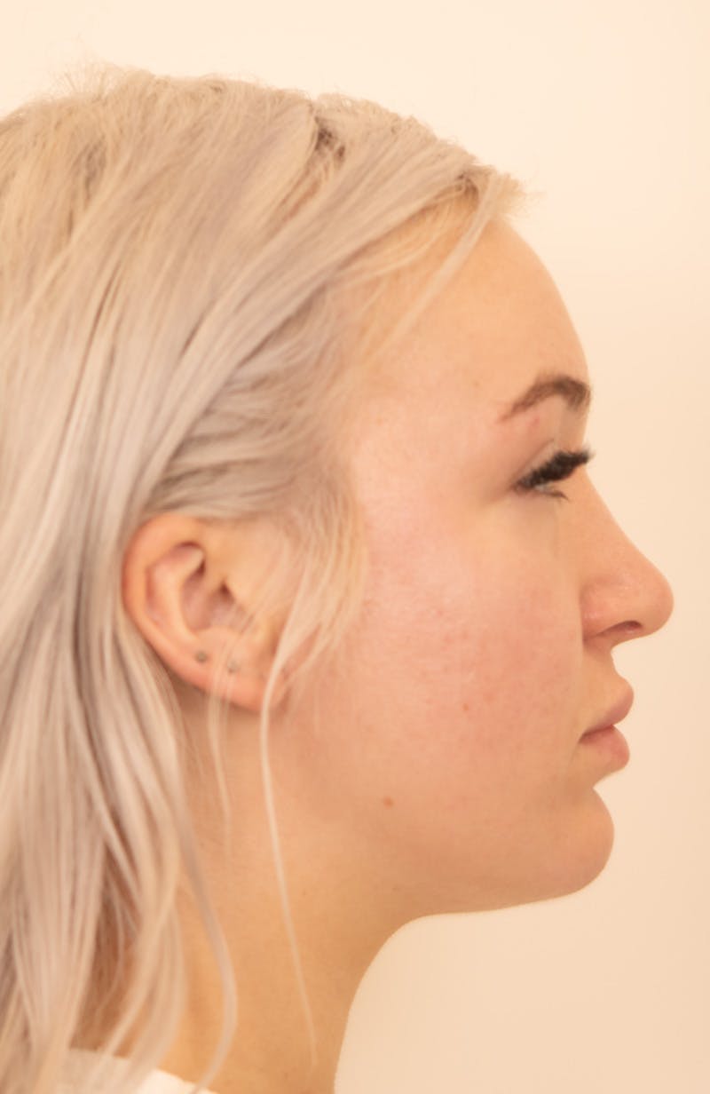 Rhinoplasty Before & After Gallery - Patient 153131 - Image 2