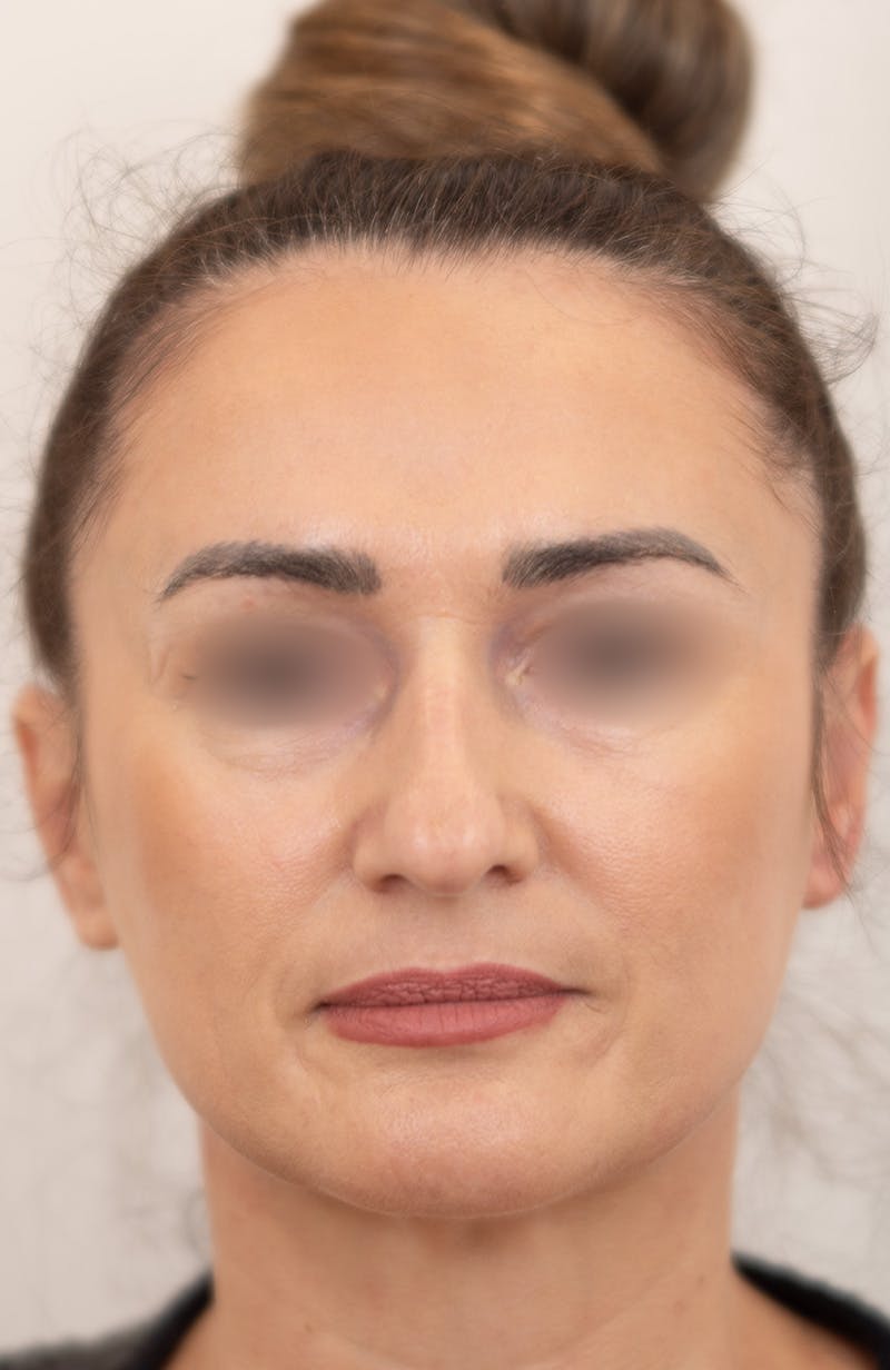 Rhinoplasty Before & After Gallery - Patient 193819 - Image 3
