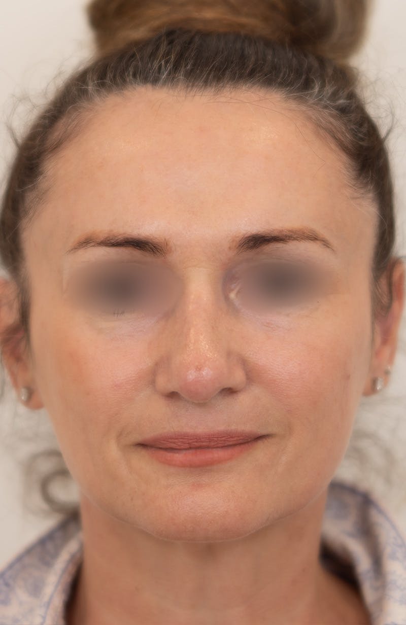 Rhinoplasty Before & After Gallery - Patient 193819 - Image 4