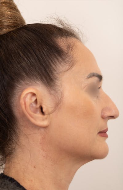Rhinoplasty Before & After Gallery - Patient 193819 - Image 1