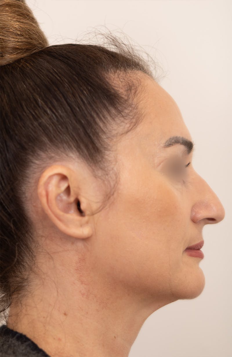 Rhinoplasty Before & After Gallery - Patient 193819 - Image 1
