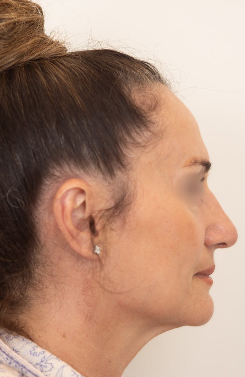 Rhinoplasty Before & After Gallery - Patient 193819 - Image 2