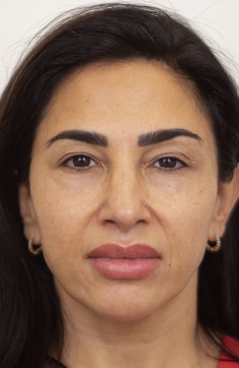 Upper Blepharoplasty Before & After Gallery - Patient 234812 - Image 1