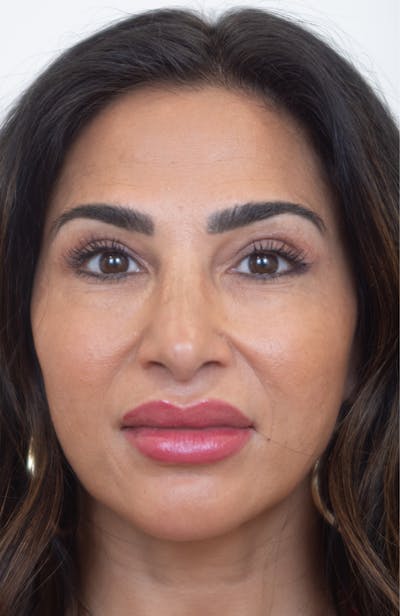 Upper Blepharoplasty Before & After Gallery - Patient 234812 - Image 2