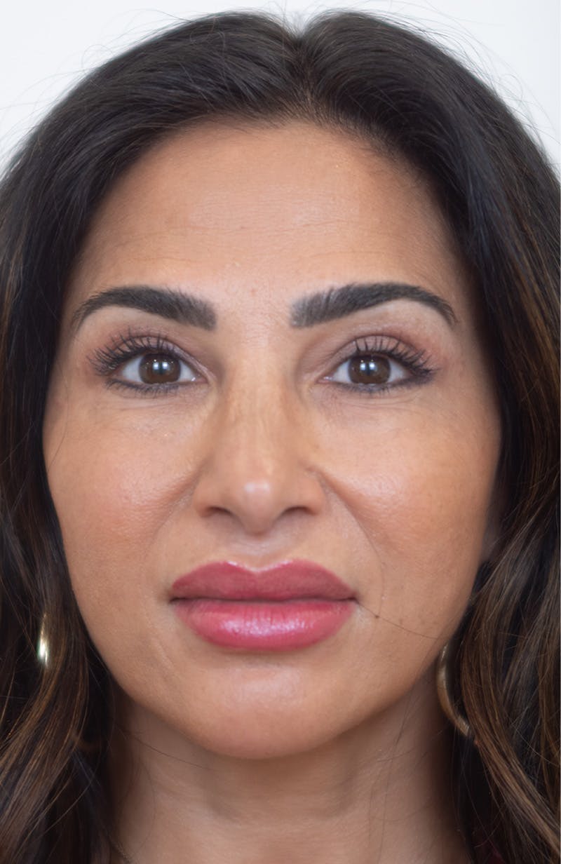 Upper Blepharoplasty Before & After Gallery - Patient 234812 - Image 2