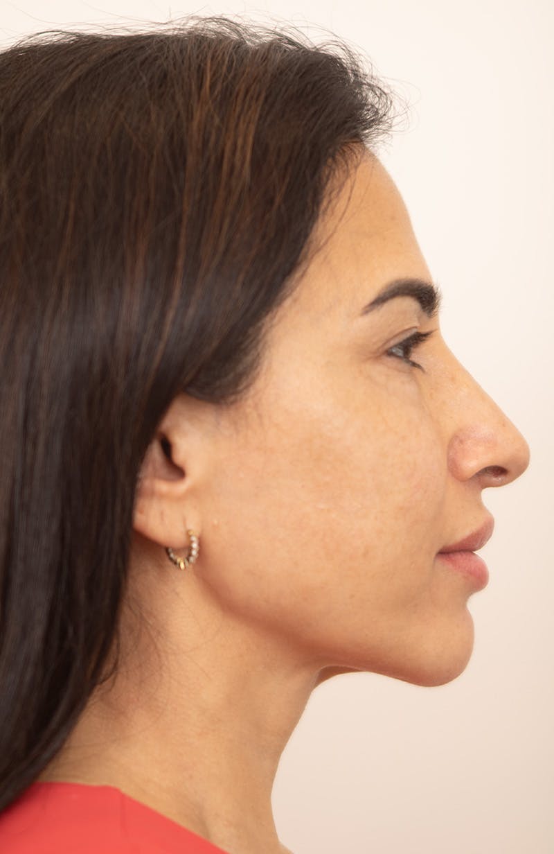 Upper Blepharoplasty Before & After Gallery - Patient 234812 - Image 3