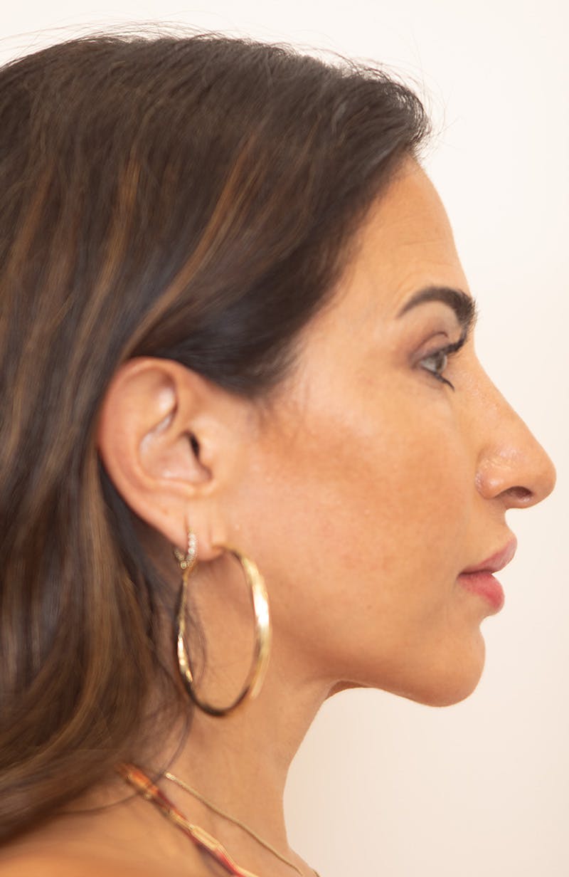Upper Blepharoplasty Before & After Gallery - Patient 234812 - Image 4