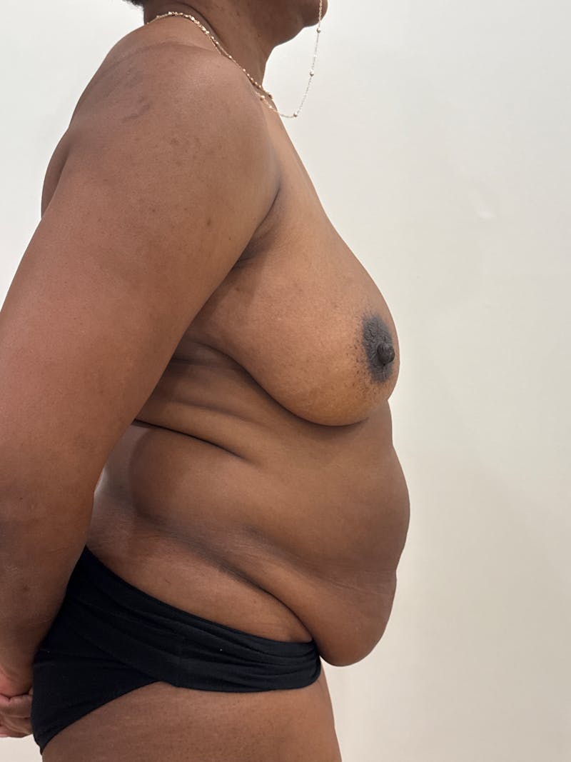 Mommy Makeover Before & After Gallery - Patient 142108 - Image 6