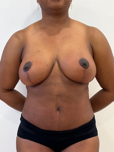 Mommy Makeover Before & After Gallery - Patient 142108 - Image 2
