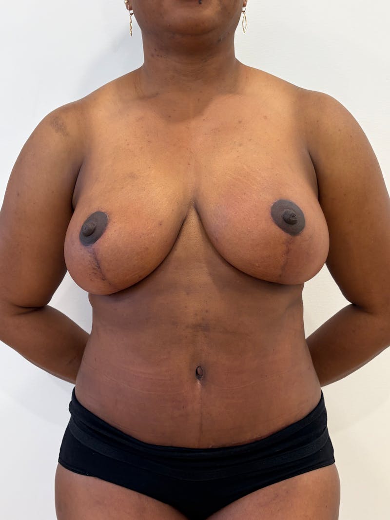 Mommy Makeover Before & After Gallery - Patient 142108 - Image 2