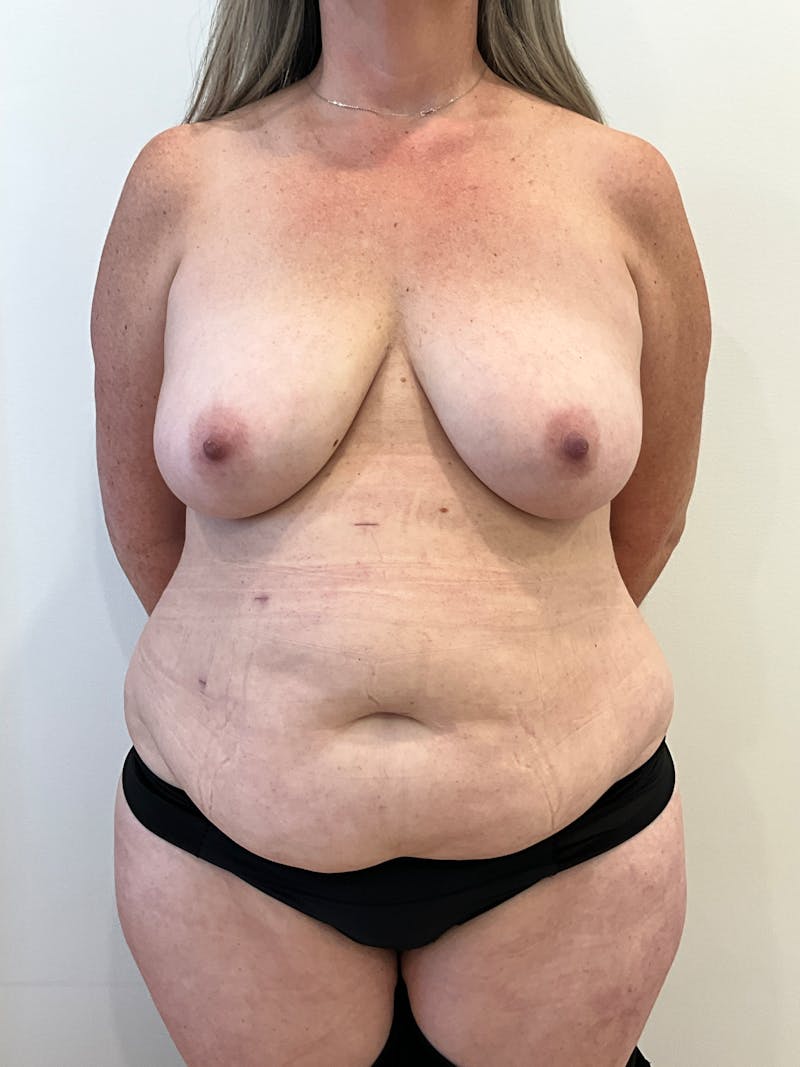 Mommy Makeover Before & After Gallery - Patient 298234 - Image 1