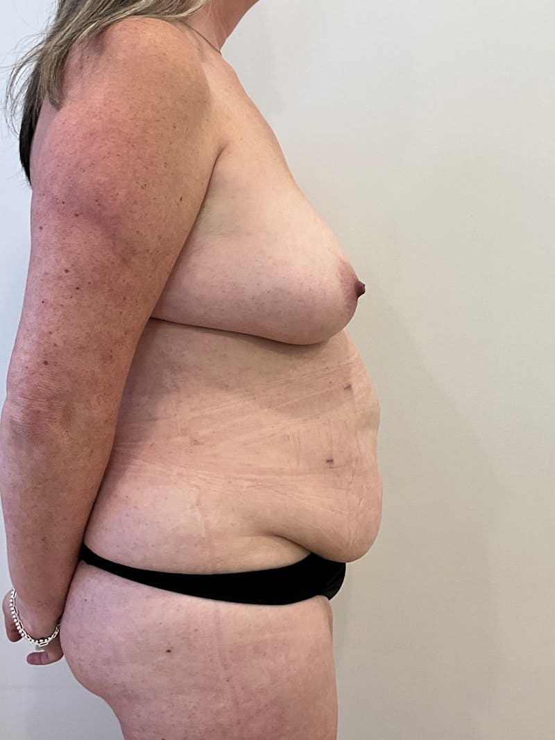 Mommy Makeover Before & After Gallery - Patient 298234 - Image 5