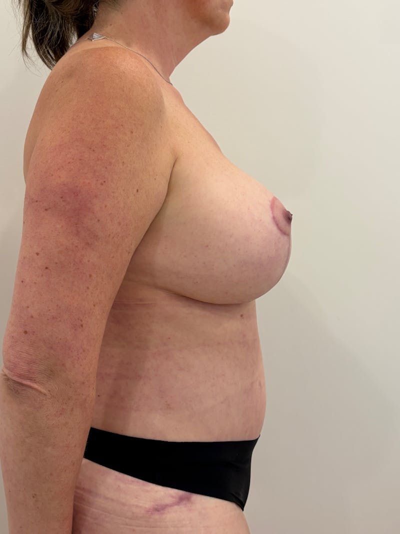 Mommy Makeover Before & After Gallery - Patient 298234 - Image 6