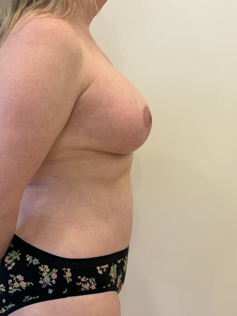 Mommy Makeover Before & After Gallery - Patient 411090 - Image 6