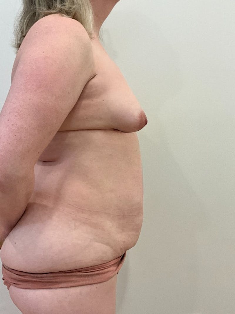 Mommy Makeover Before & After Gallery - Patient 411090 - Image 5