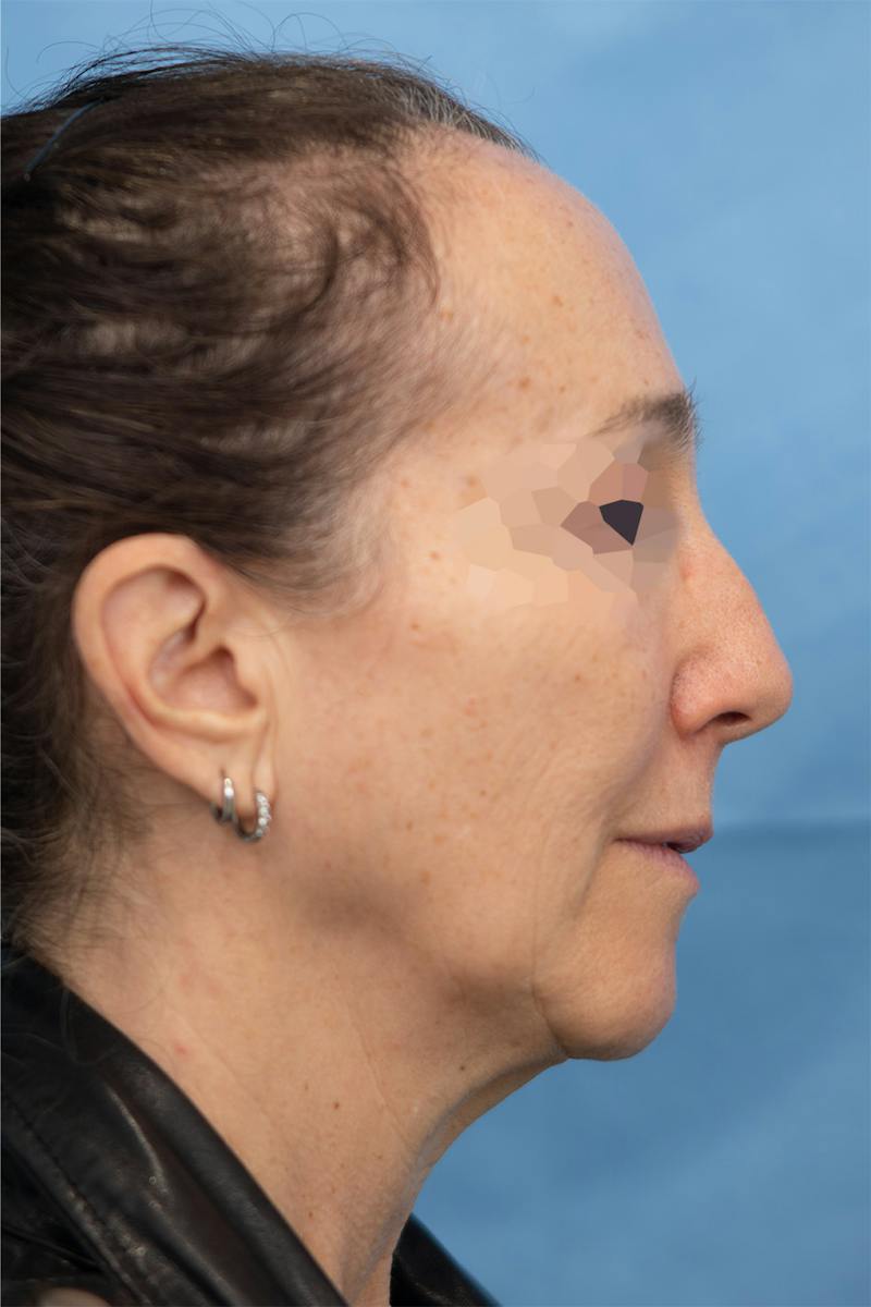 Facial Rejuvenation Before & After Gallery - Patient 789536 - Image 1