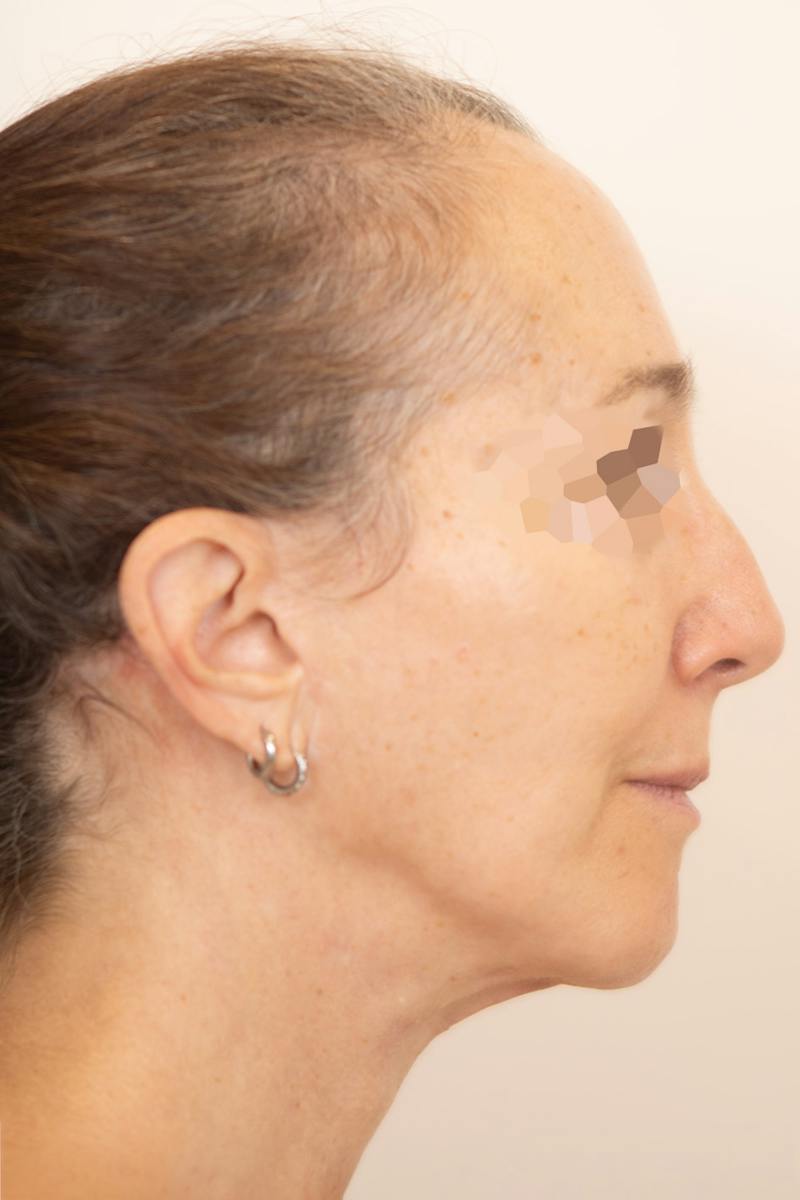 Facial Rejuvenation Before & After Gallery - Patient 789536 - Image 2