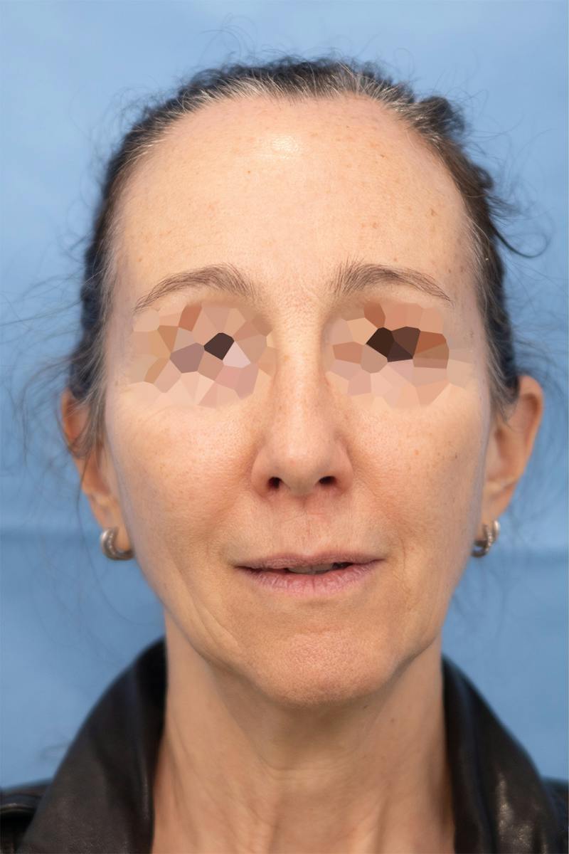 Facial Rejuvenation Before & After Gallery - Patient 789536 - Image 3