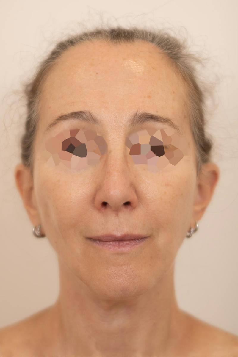 Facial Rejuvenation Before & After Gallery - Patient 789536 - Image 4