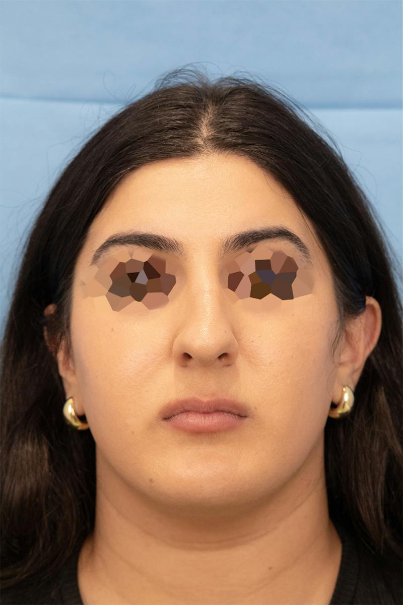 Facial Rejuvenation Before & After Gallery - Patient 303304 - Image 3