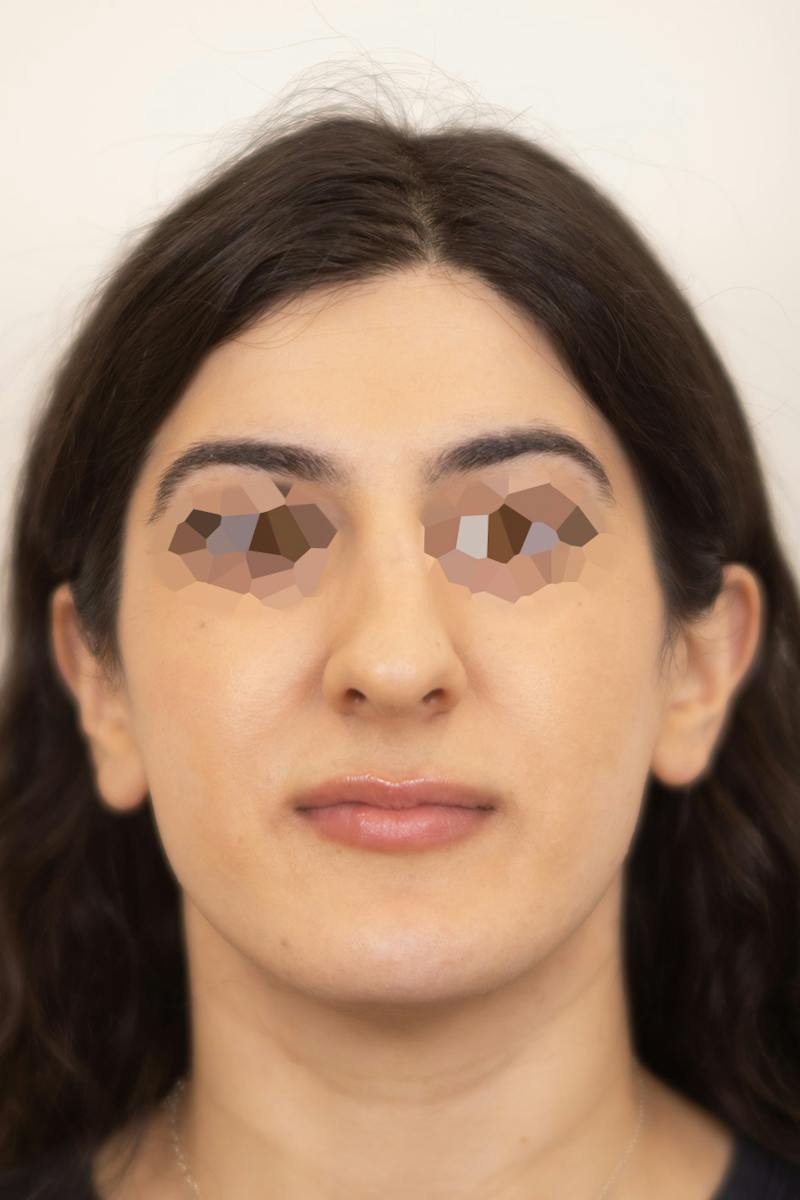 Facial Rejuvenation Before & After Gallery - Patient 303304 - Image 4