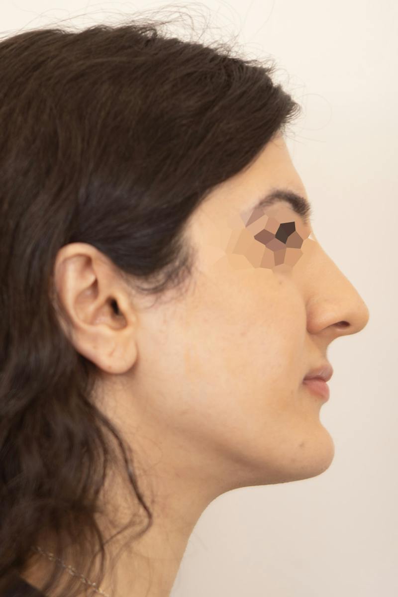 Facial Rejuvenation Before & After Gallery - Patient 303304 - Image 2