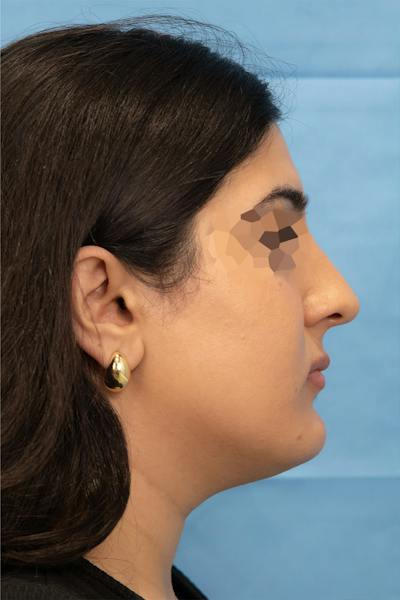 Facial Rejuvenation Before & After Gallery - Patient 303304 - Image 1