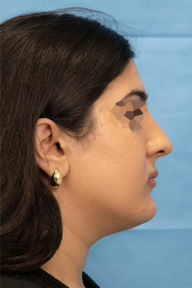 Facial Rejuvenation Before & After Gallery - Patient 303304 - Image 1