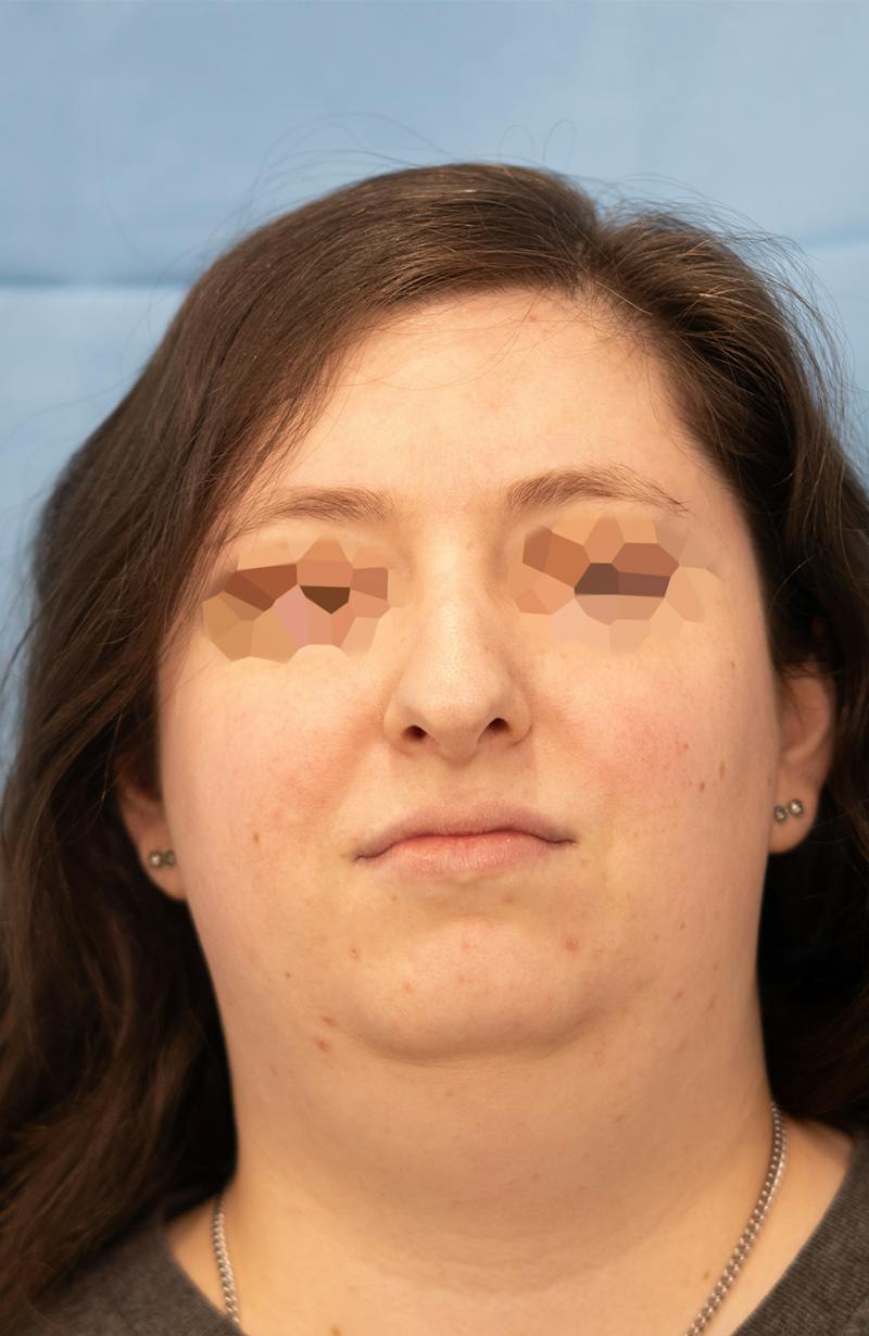 Facial Rejuvenation Before & After Gallery - Patient 307179 - Image 3