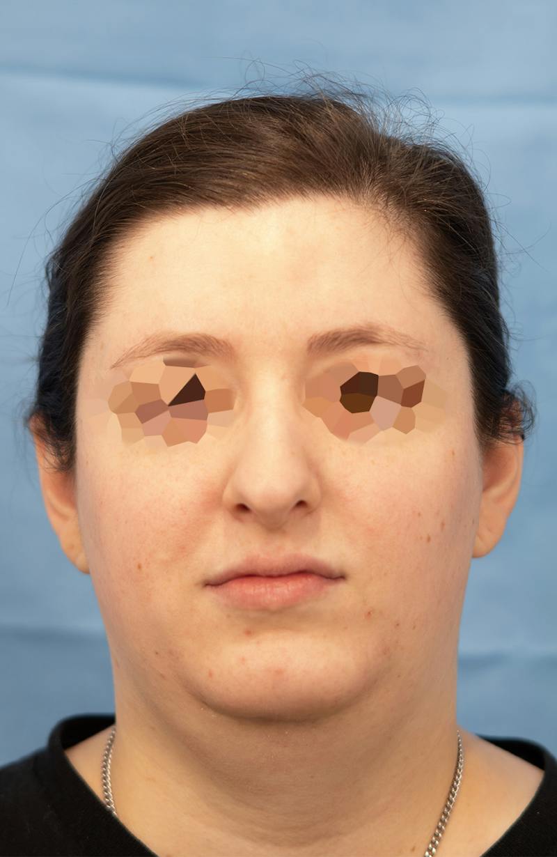 Facial Rejuvenation Before & After Gallery - Patient 307179 - Image 4