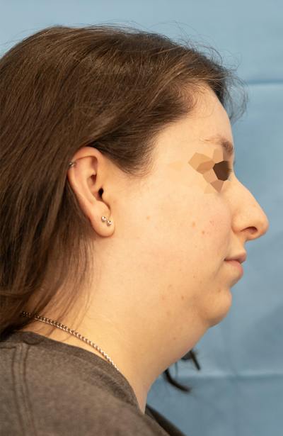 Facial Rejuvenation Before & After Gallery - Patient 307179 - Image 1