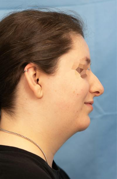 Facial Rejuvenation Before & After Gallery - Patient 307179 - Image 2