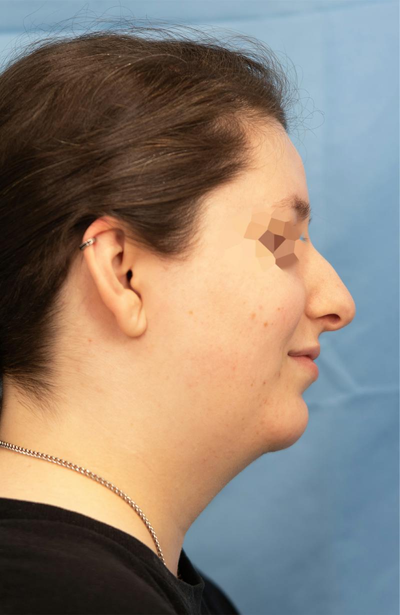 Facial Rejuvenation Before & After Gallery - Patient 307179 - Image 2