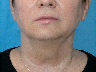 Facial Rejuvenation Before & After Gallery - Patient 313432 - Image 1
