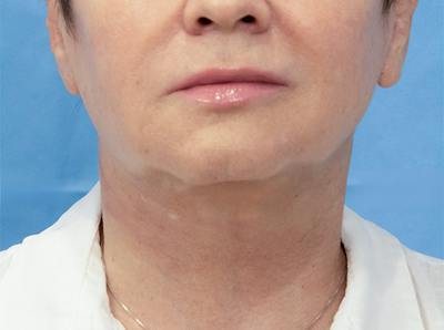 Facial Rejuvenation Before & After Gallery - Patient 313432 - Image 2