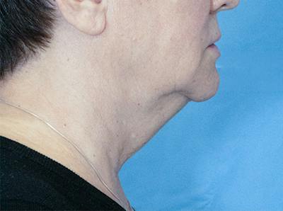 Neck Before & After Gallery - Patient 313432 - Image 1