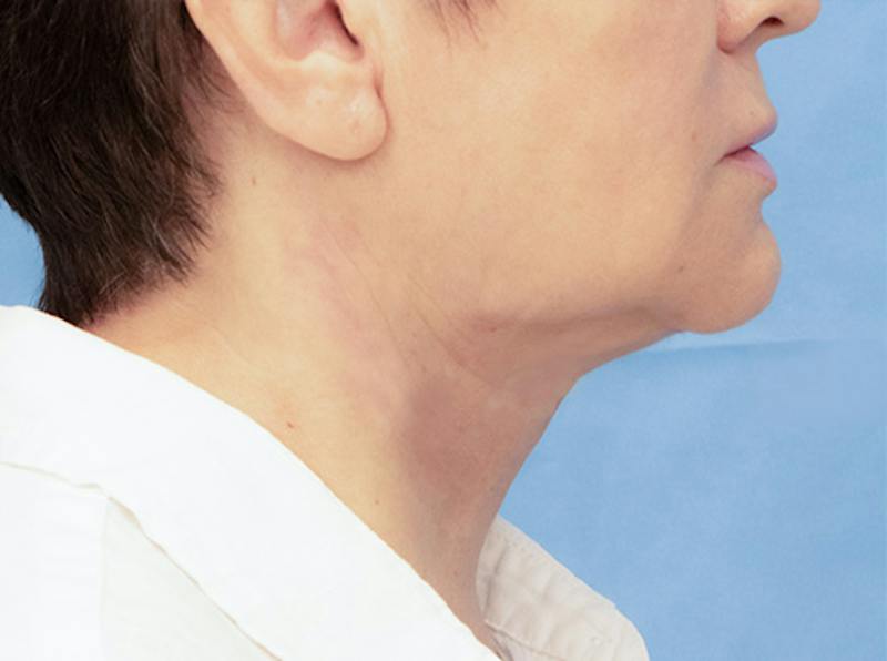 Facial Rejuvenation Before & After Gallery - Patient 313432 - Image 4