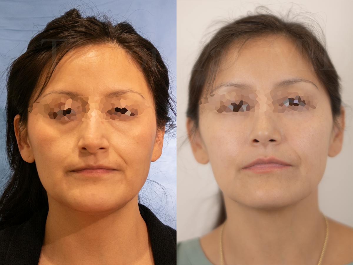 Rhinoplasty Before & After Gallery - Patient 196566 - Image 2