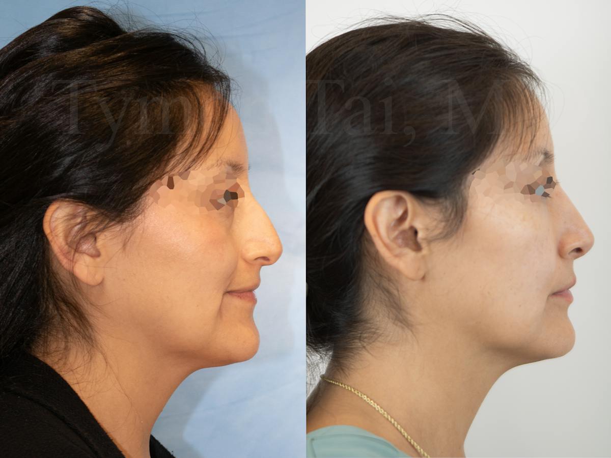 Rhinoplasty Before & After Gallery - Patient 196566 - Image 1