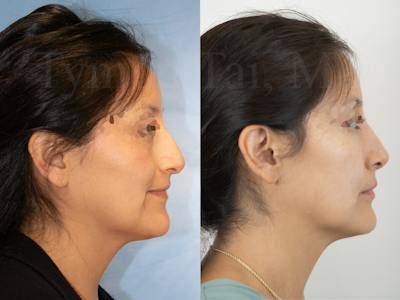 Rhinoplasty Before & After Gallery - Patient 196566 - Image 1