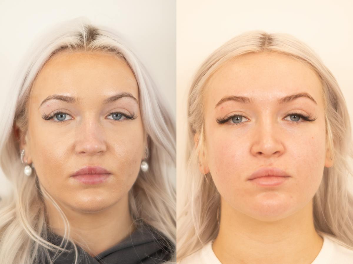 Rhinoplasty Before & After Gallery - Patient 720575 - Image 2