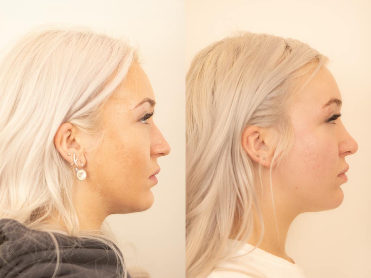 Rhinoplasty Before & After Gallery - Patient 720575 - Image 1