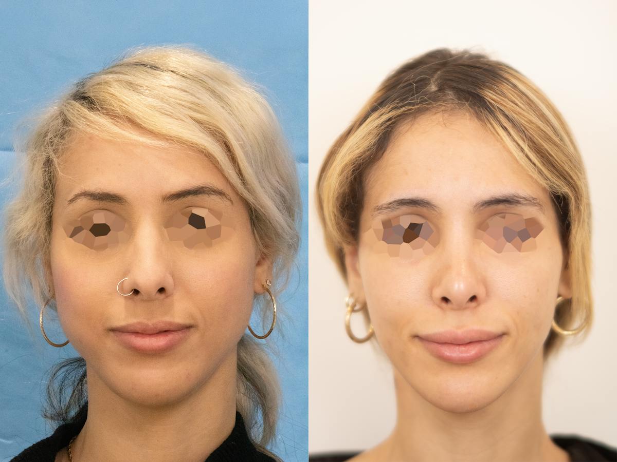 Rhinoplasty Before & After Gallery - Patient 402723 - Image 2